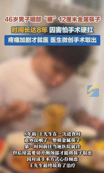 九游服务-46岁男子咽部“藏”12厘米金属筷子，时间长达8年，偶感不适，以为饮酒后正常反应